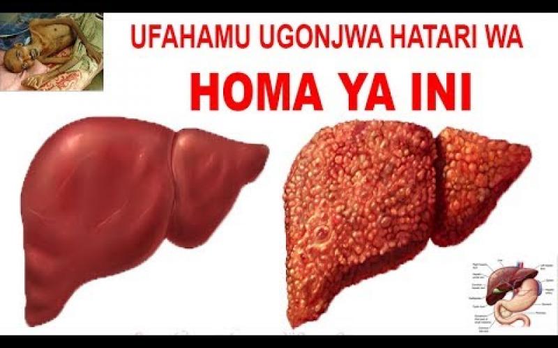 Magonjwa yanayosababishwa na virusi yapo mengi lakini ugonjwa huu wa homa ya ini chanjo yake inapatikana,